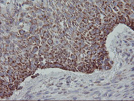 MRPS27 Antibody - IHC of paraffin-embedded Carcinoma of Human lung tissue using anti-MRPS27 mouse monoclonal antibody.