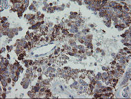 MRPS27 Antibody - IHC of paraffin-embedded Carcinoma of Human pancreas tissue using anti-MRPS27 mouse monoclonal antibody.
