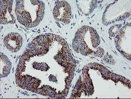 MRPS27 Antibody - IHC of paraffin-embedded Carcinoma of Human prostate tissue using anti-MRPS27 mouse monoclonal antibody.