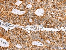 MRPS28 Antibody - Immunohistochemistry of paraffin-embedded Human colorectal cancer tissue  using MRPS28 Polyclonal Antibody at dilution of 1:105(×200)
