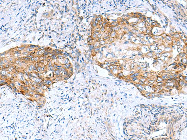 MRPS28 Antibody - Immunohistochemistry of paraffin-embedded Human cervical cancer tissue  using MRPS28 Polyclonal Antibody at dilution of 1:105(×200)