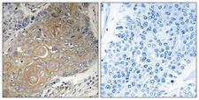 MRPS33 Antibody - Immunohistochemistry analysis of paraffin-embedded human lung carcinoma tissue, using MRPS33 Antibody. The picture on the right is blocked with the synthesized peptide.