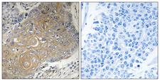 MRPS33 Antibody - Peptide - + Immunohistochemistry analysis of paraffin-embedded human lung carcinoma tissue using MRPS33 antibody.