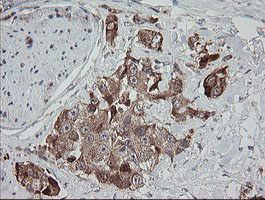 MRPS34 Antibody - IHC of paraffin-embedded Adenocarcinoma of Human breast tissue using anti-MRPS34 mouse monoclonal antibody.