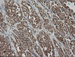 MRPS34 Antibody - IHC of paraffin-embedded Carcinoma of Human thyroid tissue using anti-MRPS34 mouse monoclonal antibody.