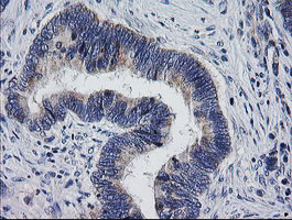 MRPS34 Antibody - IHC of paraffin-embedded Adenocarcinoma of Human colon tissue using anti-MRPS34 mouse monoclonal antibody.