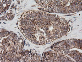 MRPS34 Antibody - IHC of paraffin-embedded Adenocarcinoma of Human ovary tissue using anti-MRPS34 mouse monoclonal antibody.