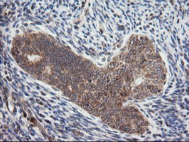 MRPS34 Antibody - IHC of paraffin-embedded Adenocarcinoma of Human endometrium tissue using anti-MRPS34 mouse monoclonal antibody.