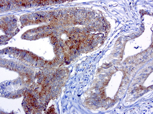 MRPS34 Antibody - Immunohistochemical staining of paraffin-embedded human colon cancer using anti-MRPS34 clone UMAB125 mouse monoclonal antibody at 1:200 dilution 1mg/mL and detection with Polink2 Broad HRP DAB.requires heat-induced epitope retrieval with citrate pH6.0 in a presure cooker for 3 minutes at 110C. The image shows membranous and cytoplasmic staining in the tumor cells.
