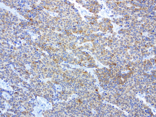 MRPS34 Antibody - Immunohistochemical staining of paraffin-embedded human lung cancer using anti-MRPS34 clone UMAB125 mouse monoclonal antibody at 1:200 dilution 1mg/mL and detection with Polink2 Broad HRP DAB.requires heat-induced epitope retrieval with citrate pH6.0 in a presure cooker for 3 minutes at 110C. The image shows membranous and cytoplasmic staining in tumor cells.