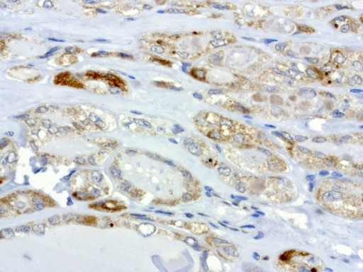 MRPS34 Antibody - Immunohistochemical staining of paraffin-embedded human thyroid cancer using anti-MRPS34 clone UMAB125 mouse monoclonal antibody at 1:200 dilution 1mg/mL and detection with Polink2 Broad HRP DAB.requires heat-induced epitope retrieval with citrate pH6.0 in a presure cooker for 3 minutes at 110C. The image shows membranous and cytoplasmic staining in tumor cells.