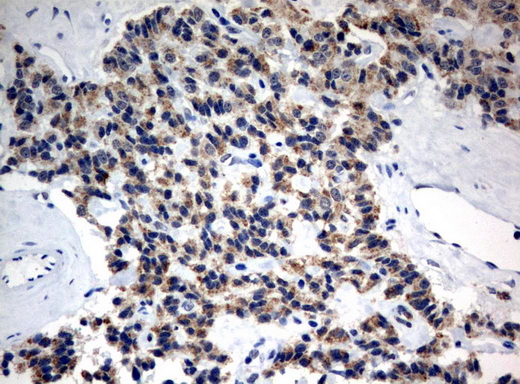 MRPS34 Antibody - Immunohistochemical staining of paraffin-embedded Carcinoma of Human pancreas tissue using anti-MRPS34 mouse monoclonal antibody.  heat-induced epitope retrieval by 10mM citric buffer, pH6.0, 120C for 3min)