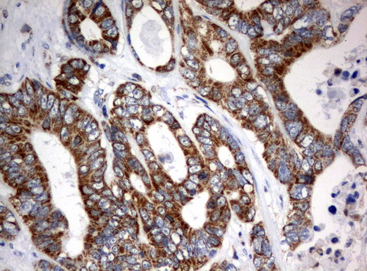 MRPS34 Antibody - Immunohistochemical staining of paraffin-embedded Adenocarcinoma of Human colon tissue using anti-MRPS34 mouse monoclonal antibody.  heat-induced epitope retrieval by 10mM citric buffer, pH6.0, 120C for 3min)