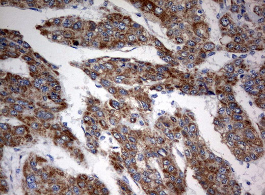 MRPS34 Antibody - Immunohistochemical staining of paraffin-embedded Carcinoma of Human liver tissue using anti-MRPS34mouse monoclonal antibody.  heat-induced epitope retrieval by 10mM citric buffer, pH6.0, 120C for 3min)
