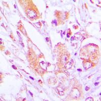 MRPS35 Antibody - Immunohistochemical analysis of MRPS35 staining in human lung cancer formalin fixed paraffin embedded tissue section. The section was pre-treated using heat mediated antigen retrieval with sodium citrate buffer (pH 6.0). The section was then incubated with the antibody at room temperature and detected using an HRP conjugated compact polymer system. DAB was used as the chromogen. The section was then counterstained with hematoxylin and mounted with DPX.