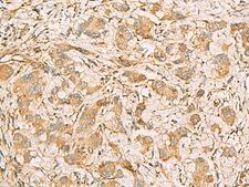 MRPS35 Antibody - Immunohistochemistry of paraffin-embedded Human liver cancer tissue  using MRPS35 Polyclonal Antibody at dilution of 1:60(×200)