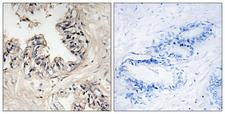 MRPS36 Antibody - Immunohistochemistry analysis of paraffin-embedded human prostate carcinoma tissue, using MRPS36 Antibody. The picture on the right is blocked with the synthesized peptide.