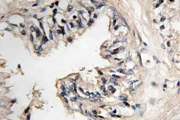 MRPS36 Antibody - IHC of MRP-S36 (V36) pAb in paraffin-embedded human prostate carcinoma tissue.