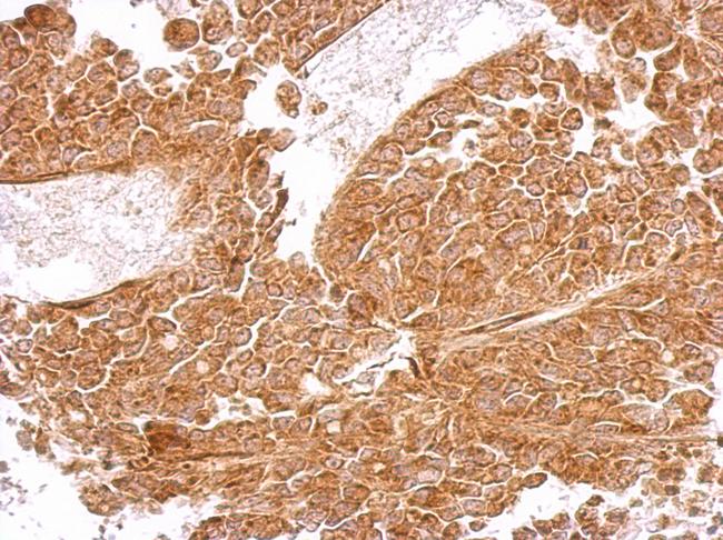 MRPS5 Antibody - MRPS5 antibody detects MRPS5 protein at cytosol on AGS xenograft by immunohistochemical analysis. Sample: Paraffin-embedded AGS xenograft. MRPS5 antibody dilution:1:500.
