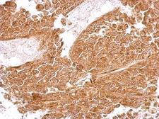 MRPS5 Antibody - MRPS5 antibody detects MRPS5 protein at cytosol on AGS xenograft by immunohistochemical analysis. Sample: Paraffin-embedded AGS xenograft. MRPS5 antibody dilution:1:500.