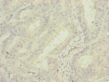 MRPS6 / MRP S6 Antibody - Immunohistochemistry of paraffin-embedded human endometrial cancer at dilution of 1:100