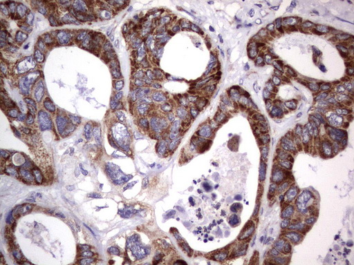 MRPS7 Antibody - Immunohistochemical staining of paraffin-embedded Adenocarcinoma of Human colon tissue using anti-MRPS7 mouse monoclonal antibody.  heat-induced epitope retrieval by 1 mM EDTA in 10mM Tris, pH9.0, 120C for 3min)