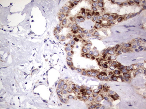 MRPS7 Antibody - Immunohistochemical staining of paraffin-embedded Carcinoma of Human liver tissue using anti-MRPS7 mouse monoclonal antibody.  heat-induced epitope retrieval by 1 mM EDTA in 10mM Tris, pH9.0, 120C for 3min)