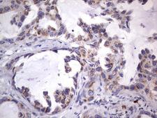 MRPS7 Antibody - Immunohistochemical staining of paraffin-embedded Carcinoma of Human lung tissue using anti-MRPS7 mouse monoclonal antibody.  heat-induced epitope retrieval by 1 mM EDTA in 10mM Tris, pH9.0, 120C for 3min)
