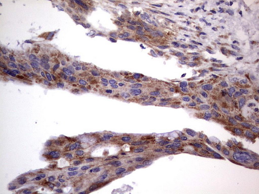 MRPS7 Antibody - Immunohistochemical staining of paraffin-embedded Carcinoma of Human pancreas tissue using anti-MRPS7 mouse monoclonal antibody.  heat-induced epitope retrieval by 1 mM EDTA in 10mM Tris, pH9.0, 120C for 3min)