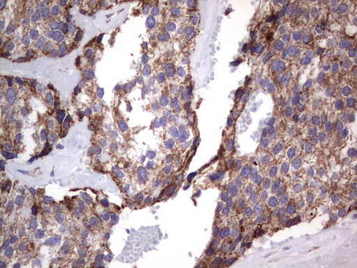 MRPS7 Antibody - Immunohistochemical staining of paraffin-embedded Adenocarcinoma of Human breast tissue using anti-MRPS7 mouse monoclonal antibody.  heat-induced epitope retrieval by 1 mM EDTA in 10mM Tris, pH9.0, 120C for 3min)