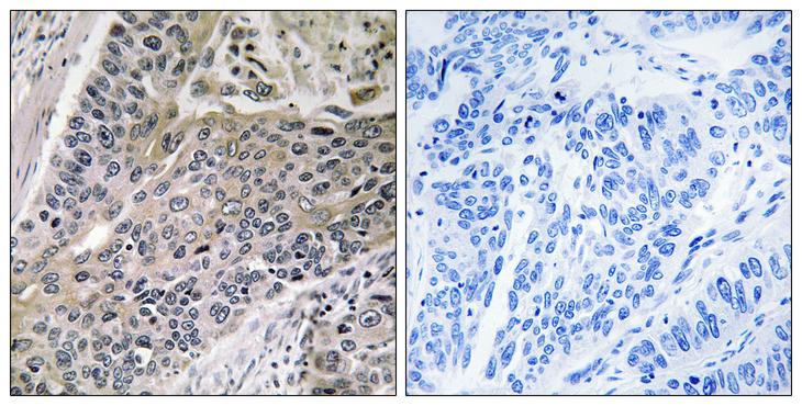 MRPS7 Antibody - Immunohistochemistry analysis of paraffin-embedded human lung carcinoma tissue, using MRPS7 Antibody. The picture on the right is blocked with the synthesized peptide.