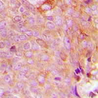 MRPS9 Antibody - Immunohistochemical analysis of MRPS9 staining in human breast cancer formalin fixed paraffin embedded tissue section. The section was pre-treated using heat mediated antigen retrieval with sodium citrate buffer (pH 6.0). The section was then incubated with the antibody at room temperature and detected with HRP and DAB as chromogen. The section was then counterstained with hematoxylin and mounted with DPX.