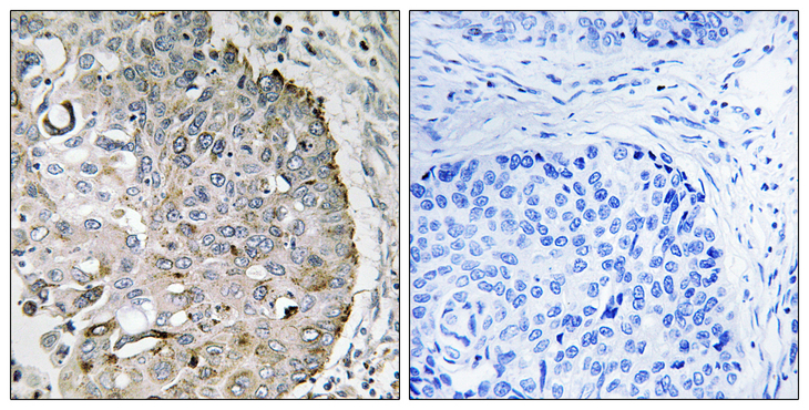 MRRF Antibody - Immunohistochemistry analysis of paraffin-embedded human lung carcinoma tissue, using MRRF Antibody. The picture on the right is blocked with the synthesized peptide.