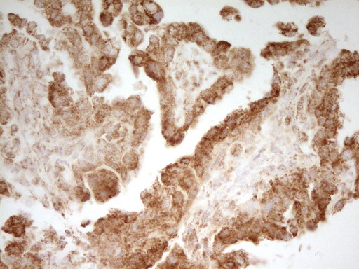 MRRF Antibody - Immunohistochemical staining of paraffin-embedded Adenocarcinoma of Human ovary tissue using anti-MRRF mouse monoclonal antibody. (Heat-induced epitope retrieval by 1 mM EDTA in 10mM Tris, pH8.5, 120C for 3min,