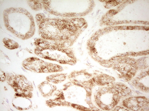 MRRF Antibody - Immunohistochemical staining of paraffin-embedded Carcinoma of Human thyroid tissue using anti-MRRF mouse monoclonal antibody. (Heat-induced epitope retrieval by 1 mM EDTA in 10mM Tris, pH8.5, 120C for 3min,