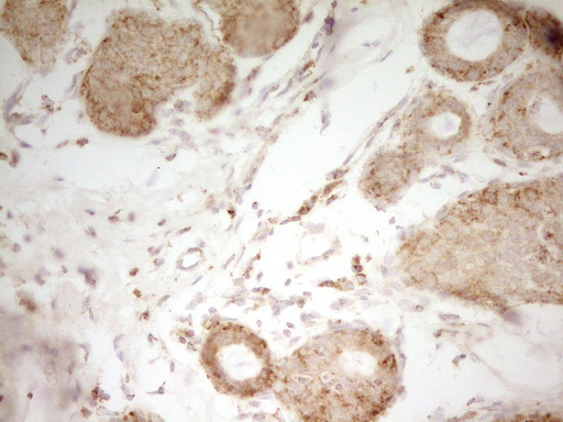MRRF Antibody - Immunohistochemical staining of paraffin-embedded Adenocarcinoma of Human breast tissue using anti-MRRF mouse monoclonal antibody. (Heat-induced epitope retrieval by 1 mM EDTA in 10mM Tris, pH8.5, 120C for 3min,