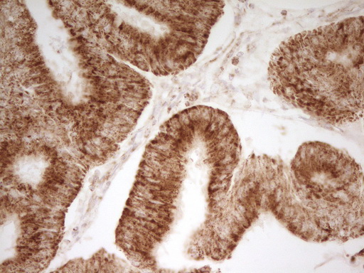 MRRF Antibody - Immunohistochemical staining of paraffin-embedded Adenocarcinoma of Human colon tissue using anti-MRRF mouse monoclonal antibody. (Heat-induced epitope retrieval by 1 mM EDTA in 10mM Tris, pH8.5, 120C for 3min,