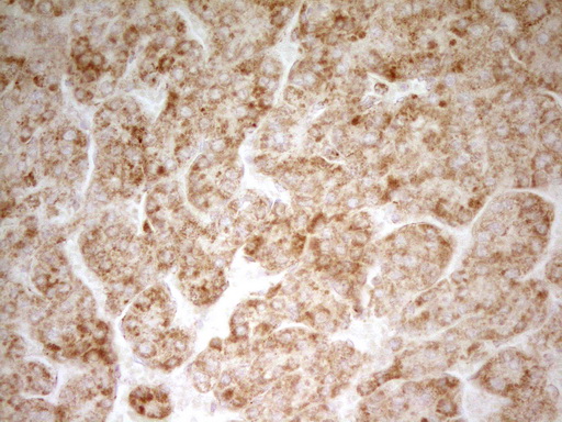 MRRF Antibody - Immunohistochemical staining of paraffin-embedded Carcinoma of Human liver tissue using anti-MRRF mouse monoclonal antibody. (Heat-induced epitope retrieval by 1 mM EDTA in 10mM Tris, pH8.5, 120C for 3min,
