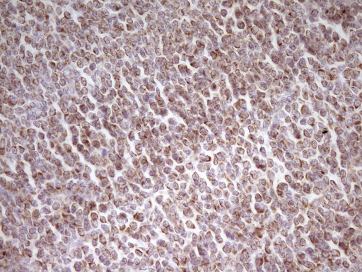 MRRF Antibody - Immunohistochemical staining of paraffin-embedded Human lymphoma tissue using anti-MRRF mouse monoclonal antibody. (Heat-induced epitope retrieval by 1 mM EDTA in 10mM Tris, pH8.5, 120C for 3min,