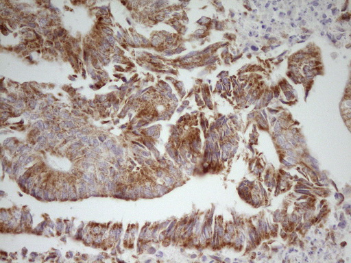 MRRF Antibody - Immunohistochemical staining of paraffin-embedded Adenocarcinoma of Human colon tissue using anti-MRRF mouse monoclonal antibody. (Heat-induced epitope retrieval by 1 mM EDTA in 10mM Tris, pH8.5, 120C for 3min,