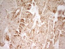 MRRF Antibody - Immunohistochemical staining of paraffin-embedded Carcinoma of Human lung tissue using anti-MRRF mouse monoclonal antibody. (Heat-induced epitope retrieval by 1 mM EDTA in 10mM Tris, pH8.5, 120C for 3min,