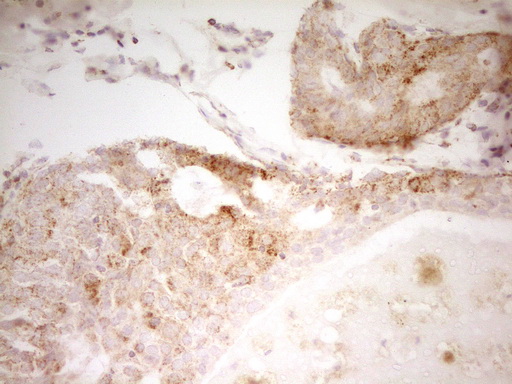 MRRF Antibody - Immunohistochemical staining of paraffin-embedded Adenocarcinoma of Human breast tissue using anti-MRRF mouse monoclonal antibody. (Heat-induced epitope retrieval by 1 mM EDTA in 10mM Tris, pH8.5, 120C for 3min,