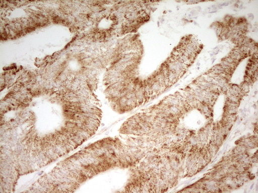 MRRF Antibody - IHC of paraffin-embedded Adenocarcinoma of Human colon tissue using anti-MRRF mouse monoclonal antibody. (Heat-induced epitope retrieval by 1 mM EDTA in 10mM Tris, pH8.5, 120°C for 3min).