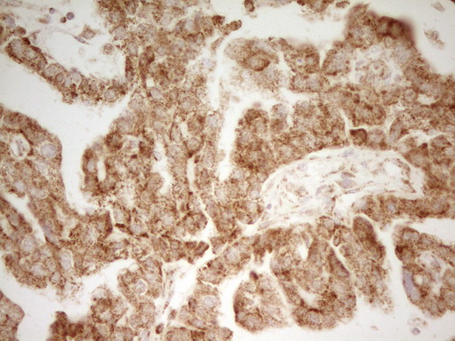 MRRF Antibody - IHC of paraffin-embedded Adenocarcinoma of Human ovary tissue using anti-MRRF mouse monoclonal antibody. (Heat-induced epitope retrieval by 1 mM EDTA in 10mM Tris, pH8.5, 120°C for 3min).