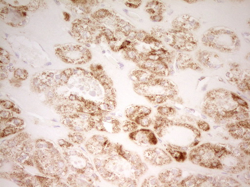 MRRF Antibody - IHC of paraffin-embedded Carcinoma of Human thyroid tissue using anti-MRRF mouse monoclonal antibody. (Heat-induced epitope retrieval by 1 mM EDTA in 10mM Tris, pH8.5, 120°C for 3min).