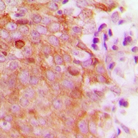 MRRF Antibody - Immunohistochemical analysis of MRRF staining in human breast cancer formalin fixed paraffin embedded tissue section. The section was pre-treated using heat mediated antigen retrieval with sodium citrate buffer (pH 6.0). The section was then incubated with the antibody at room temperature and detected with HRP and DAB as chromogen. The section was then counterstained with hematoxylin and mounted with DPX.