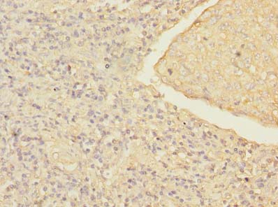 MRRF Antibody - Immunohistochemistry of paraffin-embedded human lung cancer using antibody at dilution of 1:100.