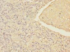MRRF Antibody - Immunohistochemistry of paraffin-embedded human lung cancer using antibody at dilution of 1:100.