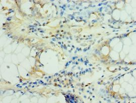MS4A12 Antibody - Immunohistochemistry of paraffin-embedded human breast cancer using antibody at 1:100 dilution.