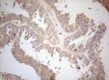 MS4A12 Antibody - Immunohistochemical staining of paraffin-embedded Adenocarcinoma of Human ovary tissue using anti-MS4A12 mouse monoclonal antibody. (Heat-induced epitope retrieval by 1mM EDTA in 10mM Tris buffer. (pH8.5) at 120°C for 3 min. (1:150)